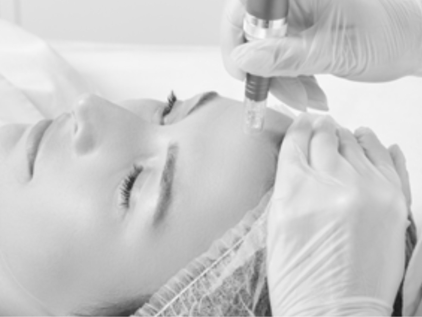 Microneedling Annecy
