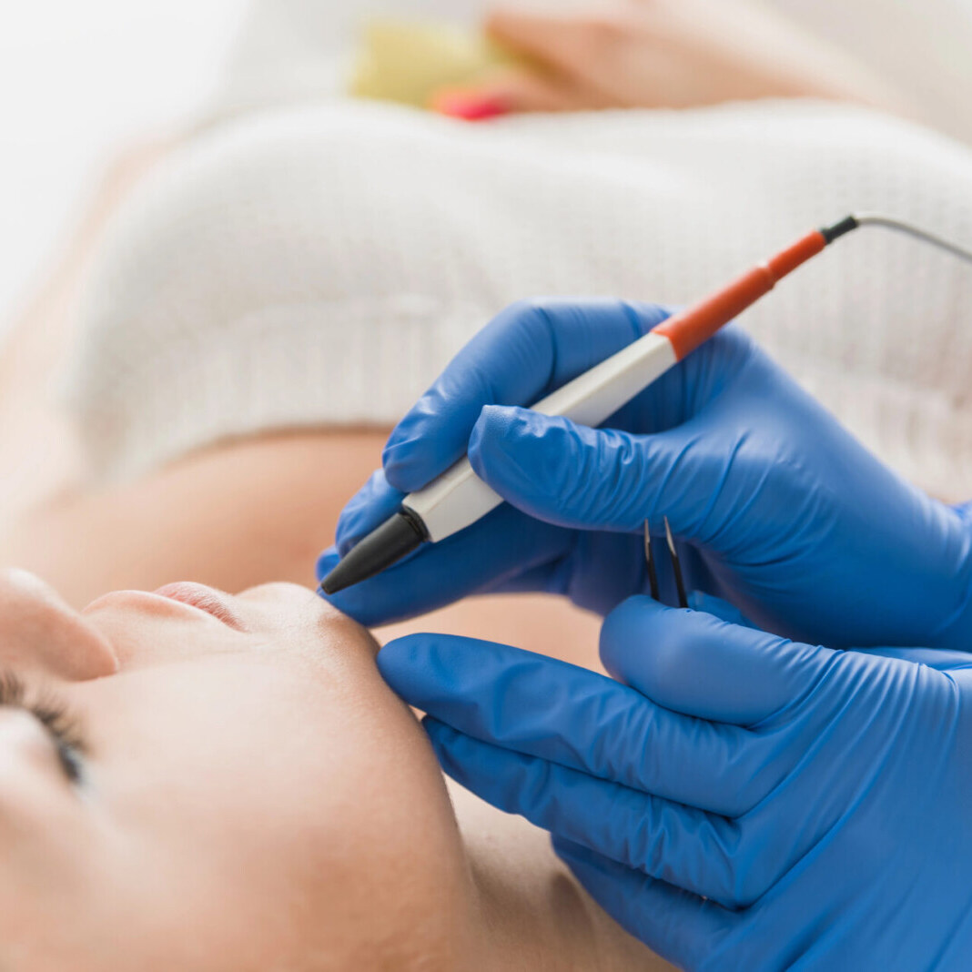 Epilation définitive par électrolyse à Annecy