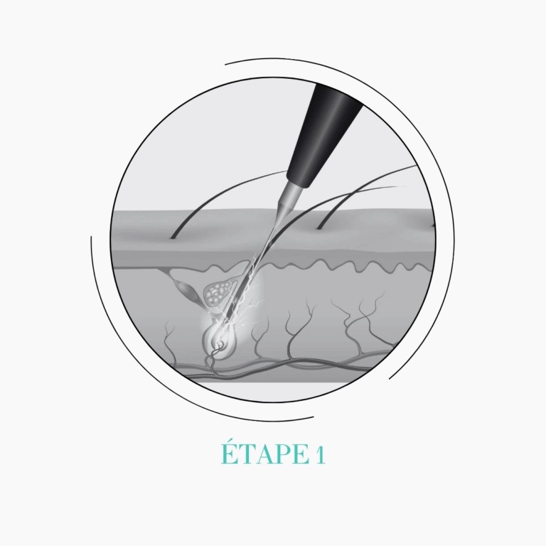 Etape 1 &eacute;pilation par &eacute;lectrolyse &agrave; Annecy